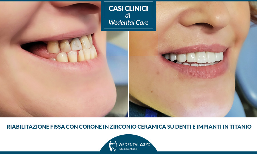 Armonizzazione della linea del sorriso: corona su impianto e ricostruzione  su dente naturale