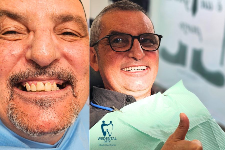 Nuova dentatura grazie a un intervento di Toronto doppia